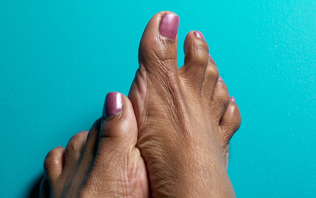 Arthritis in the Feet: Early Signs, Treatment, and Why It’s Often Overlooked in Black Patients